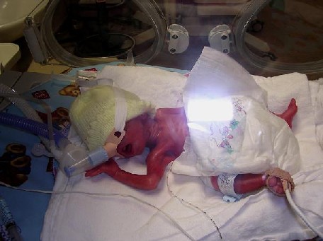 Mitchell in NICU